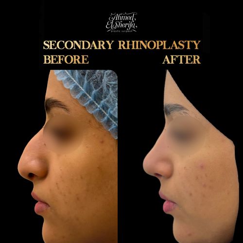 سعر عملية الأنف